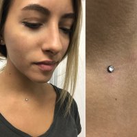 Установка микродермала 