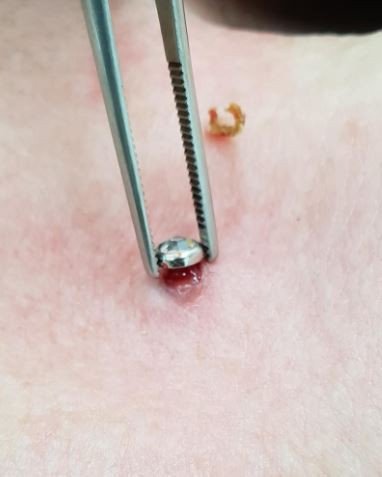 Чистка микродермала 