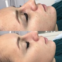 Азелаиново- миндальный пилинг Cytolife 