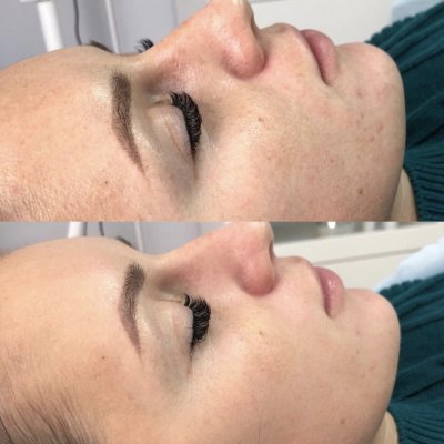 Азелаиново- миндальный пилинг Cytolife 