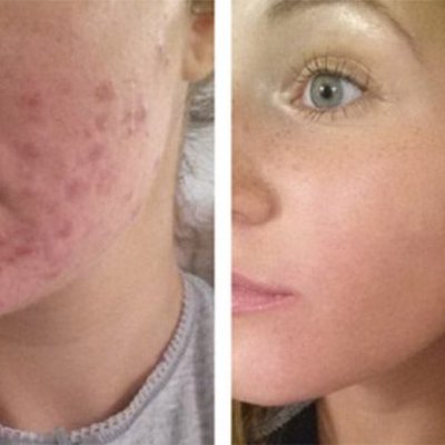 Азелаиново-миндальный Cytolife  + ГК под дермапен (лечение постакне, сузость кожи, гиперкератоз)