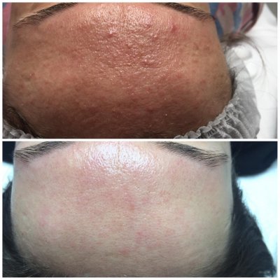 Салициловый пилинг 15%, 25% 