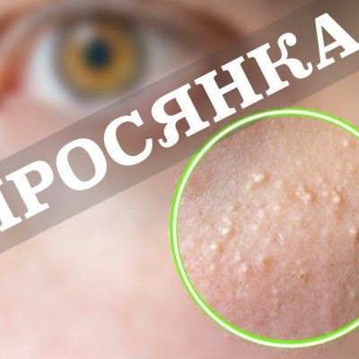 Удаление миллиумов (просянок) на лице