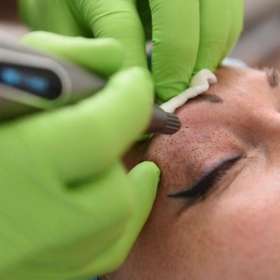 Удаление миллиумов на веках (аппаратом plasma-liner) 