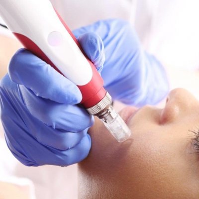 Фракционная мезотерапия с препаратом 1,5 мл по типу и проблемам кожи