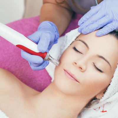 Азелаиново-миндальный Cytolife  + ГК под дермапен (лечение постакне, сузость кожи, гиперкератоз) 