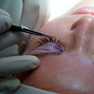 Блефаропластика верхних/нижних век  