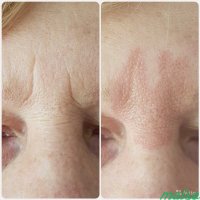 Переносица