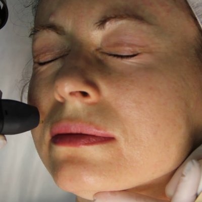 Носогубный треугольник 