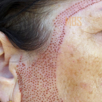 Околоушная складка 