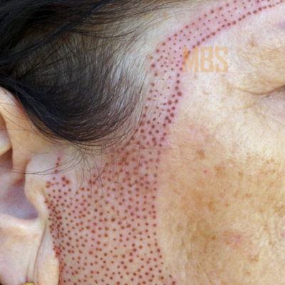 Околоушная складка 