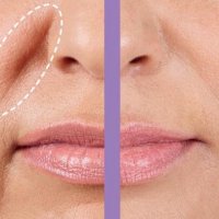 Морщины улыбки 