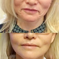 Углы рта и губоподбородочные морщины (морщины марионетки)  