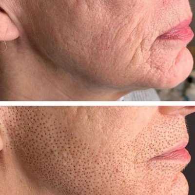 Продольные морщины овала лица 