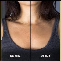 Морщины в зоне декольте 