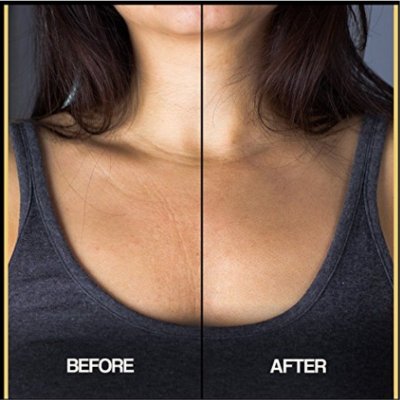 Морщины в зоне декольте 