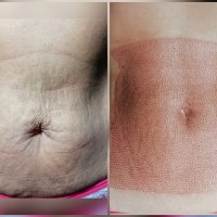 Коррекция растяжек