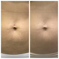 Коррекция пупка