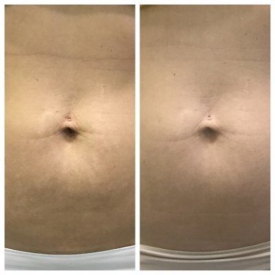 Коррекция пупка 