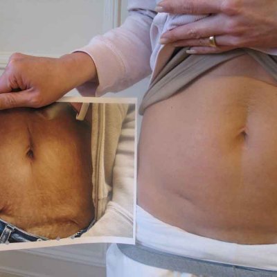 Коррекция послеродового живота 