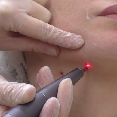 Удаление папиллом 