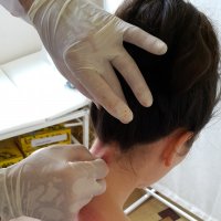 Капиллярное кровопускание.       Одна точка