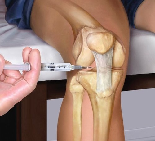 Внутрисуставная плазма