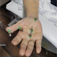  Моксотерапия су-джок (прогревание БАТ)