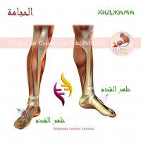 Капиллярное кровопускание.       Одна точка