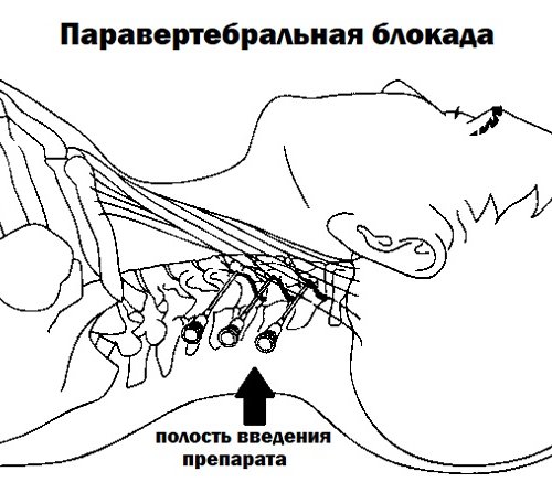 Блокады паравертебральные