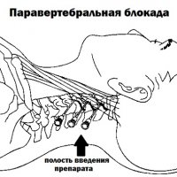 Блокады паравертебральные