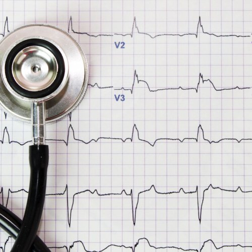 Электрокардиограмма