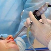 Септопластика + редукция носовых пазух