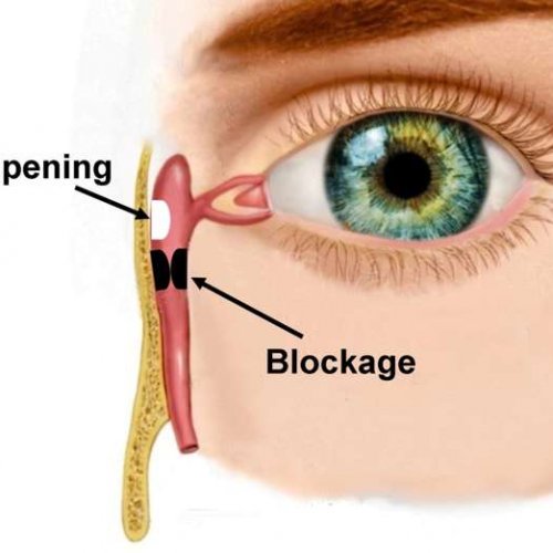 Дакриоцисториностомия (с двух сторон)