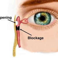 Дакриоцисториностомия (с одной стороны)