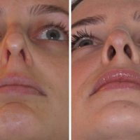 Политомия + септопластика + редукция носовых раковин