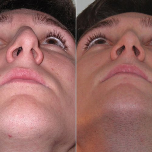 No nose is perfect. In fact, most of us have noses that are slightly crooked and