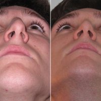 Септопластика + редукция носовых раковин под наркозом