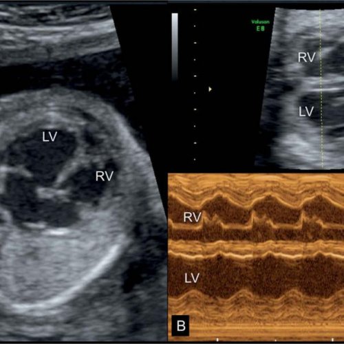 УЗИ сердца плода