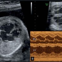 УЗИ сердца плода