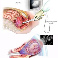 Цервикометрия