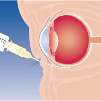 Ретросклеропломбирование 1 глаз