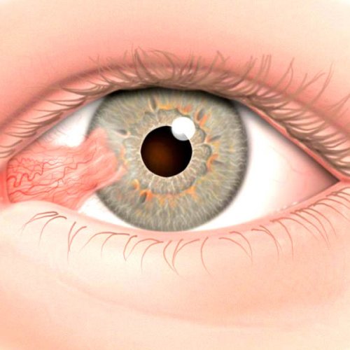 Удаление новообразований век, коньюктивы