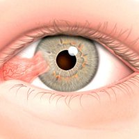 Удаление новообразований век, коньюктивы