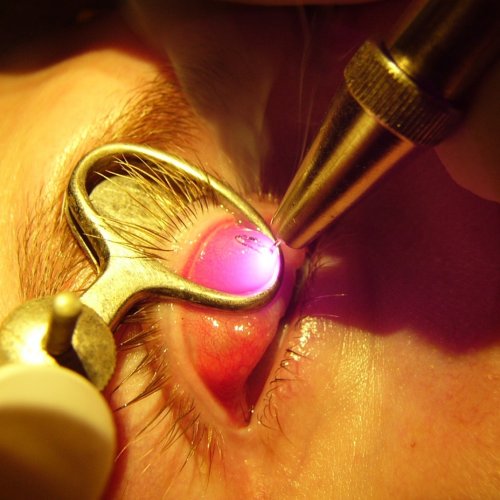 Консервативное лечение халазиона(инъекция),без стоимости препаратов