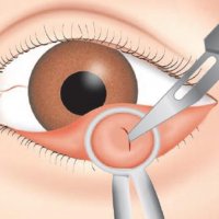 Ячмень — вскрытие и лечение