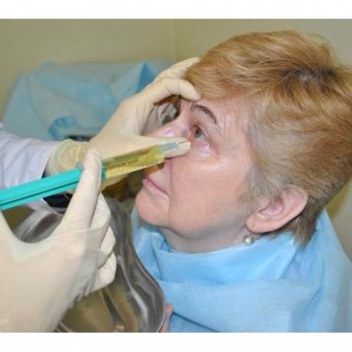 Промывание слезных путей у взрослых (1глаз)