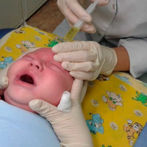 Зондирование слезных путей(дети) один глаз