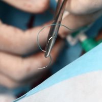 Снятие швов