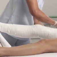 Наложение большой гипсовой перевязки